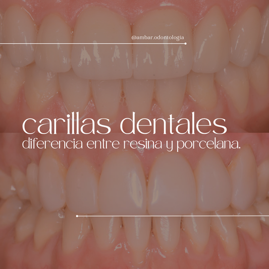 ¿Carillas dentales de resina o porcelana? Conoce sus diferencias