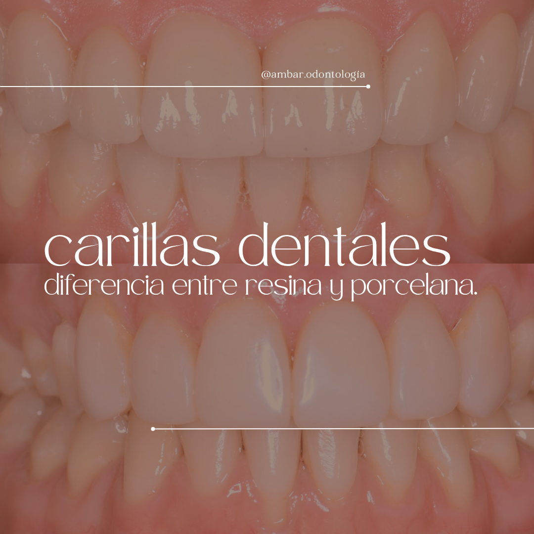 ¿Carillas dentales de resina o porcelana? Conoce sus diferencias