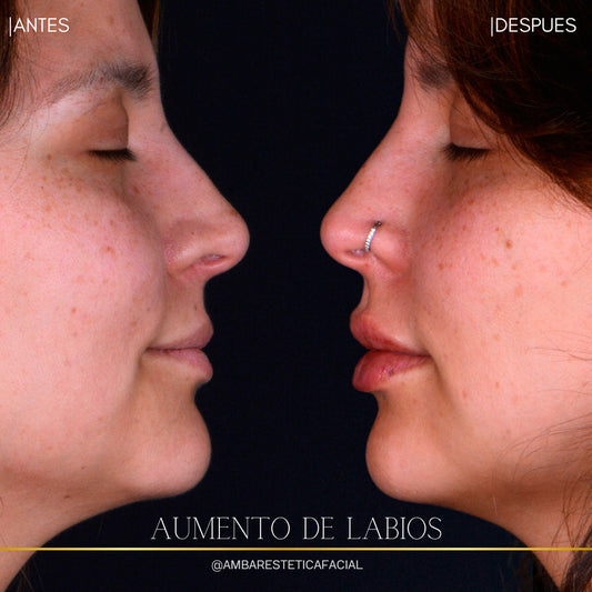 Todo lo que necesitas saber sobre el aumento de labios